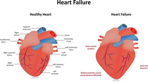 global lv hypokinesia|left ventricle not pumping properly.